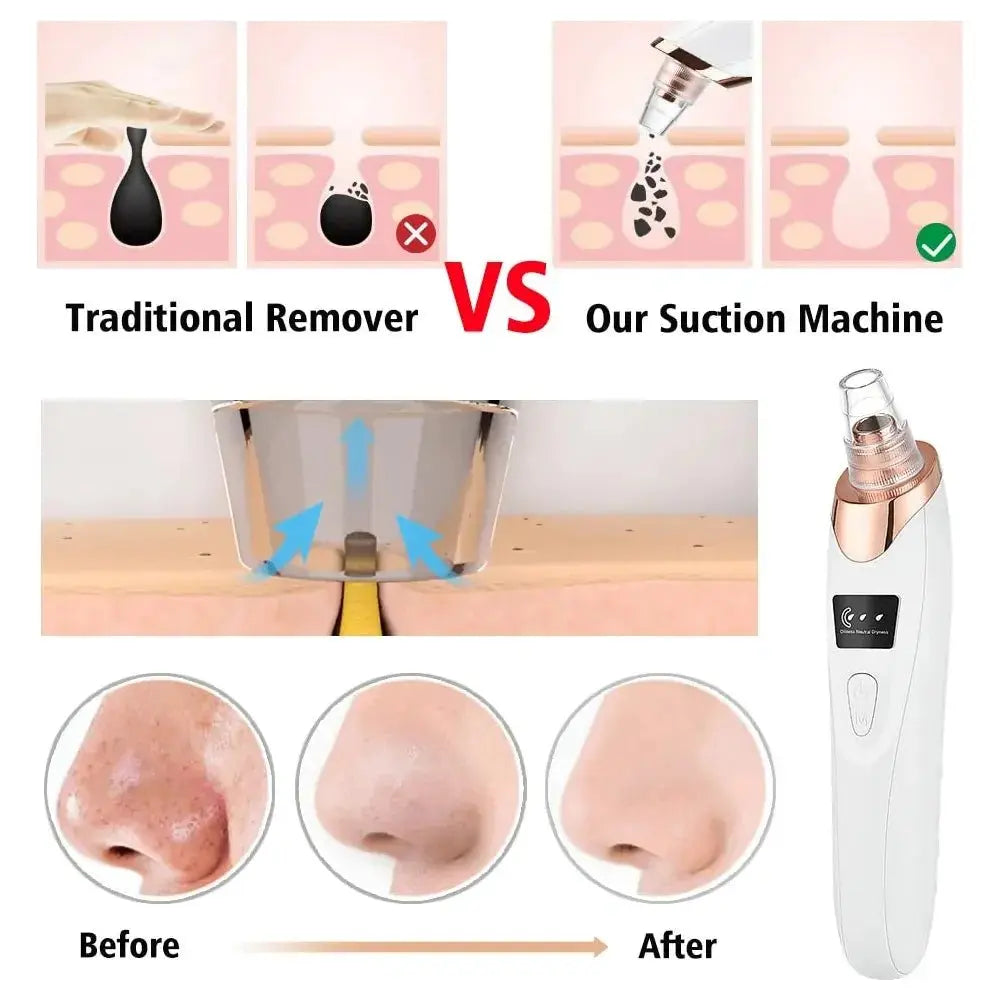 Blackhead Remover Vacuum – Acne, Pimple & Black Spot Treatment - Glam Global UK