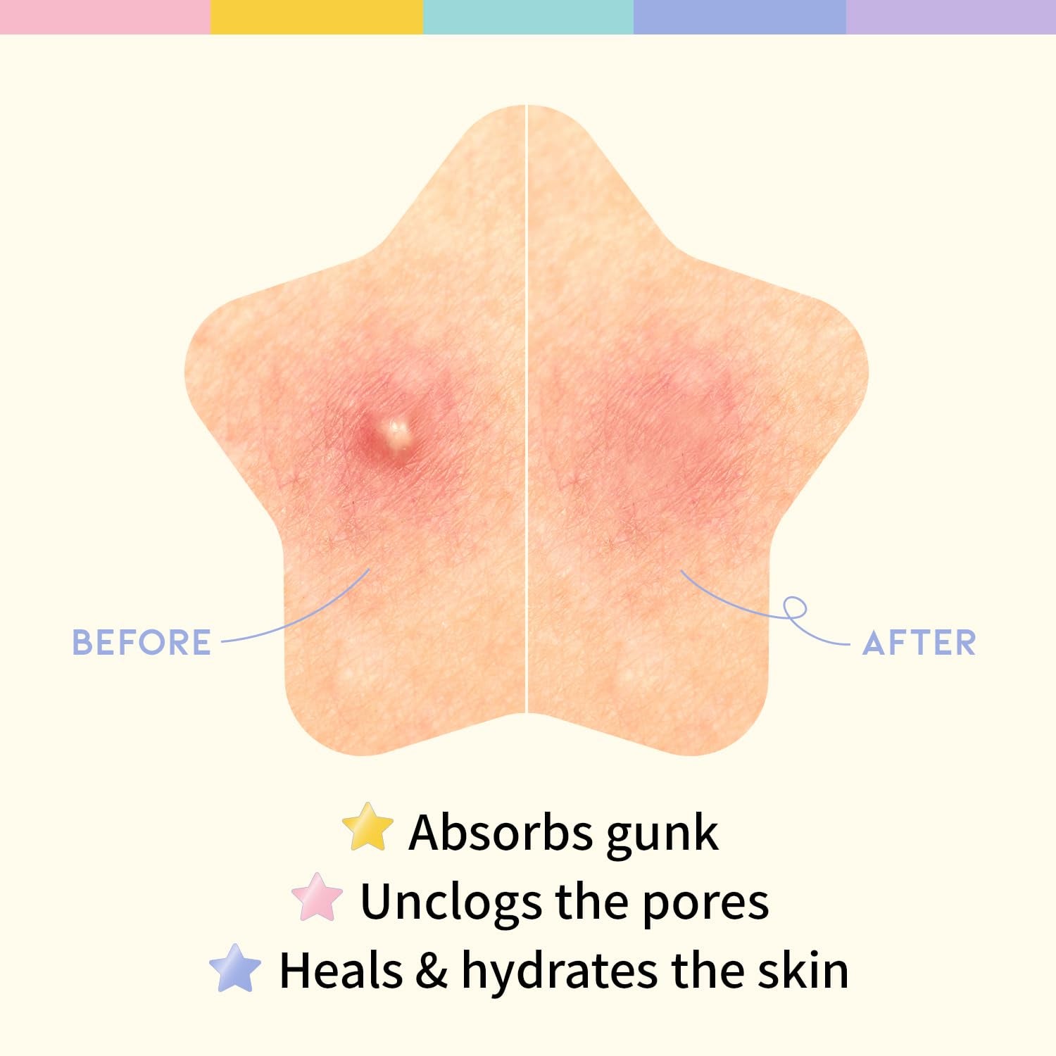 #OOTD Hydrocolloid Blemish Care Star Spot Patch - 80 Patches