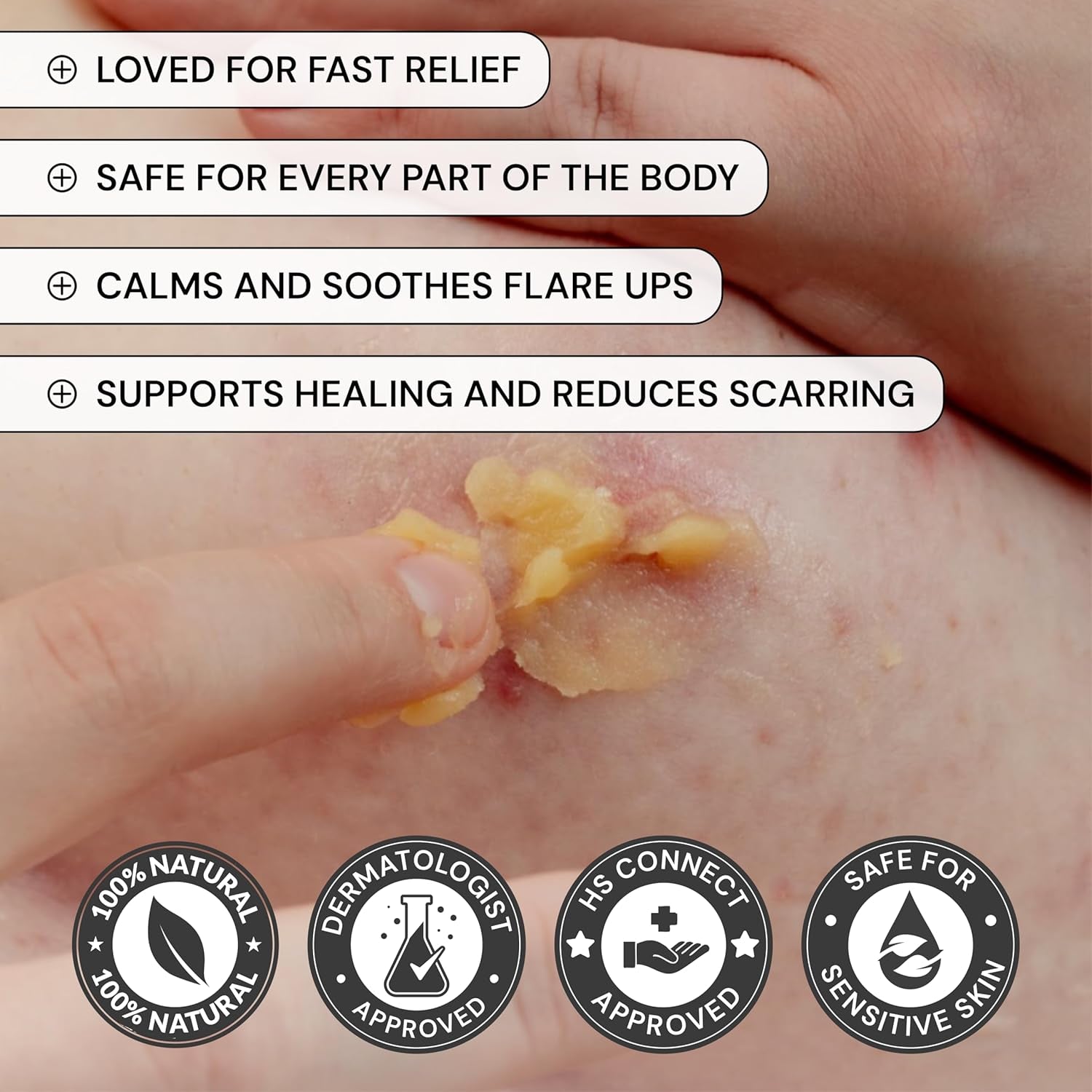 MyMagicHealer Universal Flare Care – 4oz (113g) | Natural Relief for HS, Boils, Abscesses & Skin Flare-Ups