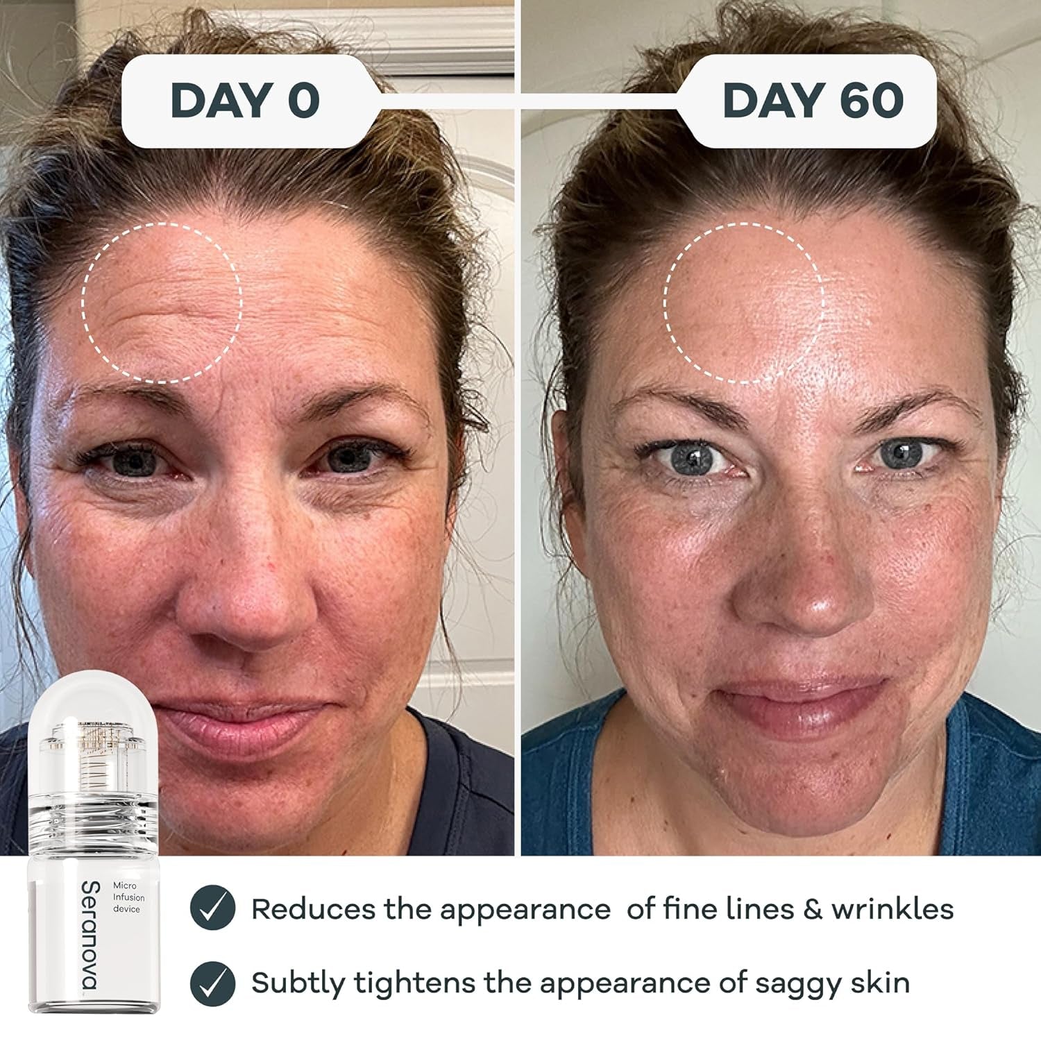 Seranova MicroNeedling Infusion Kit - 2-Month Supply