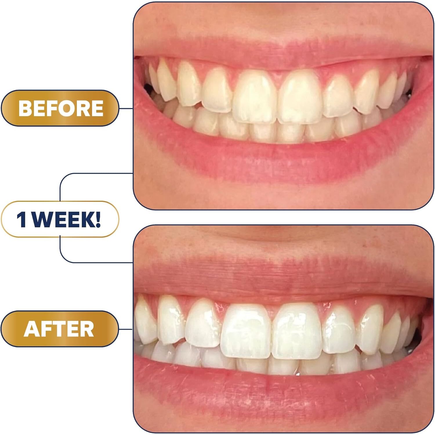 Lumineux Whitening Strips – 42 Strips, 21 Treatments | Enamel-Safe, Sensitivity-Free Teeth Whitening