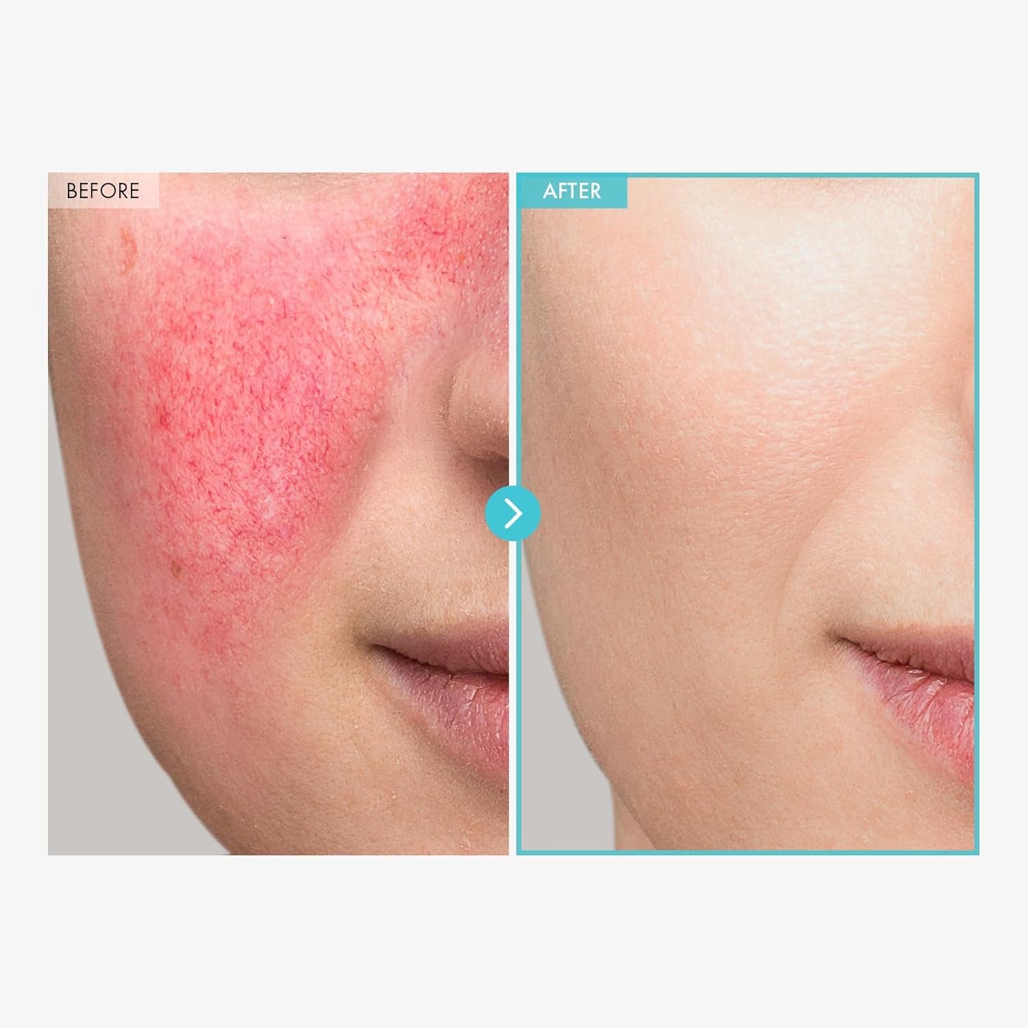 SOS Repair CICA Clinic Zinc Cream, 100,000Ppm Zinc Oxide, Heal, Soothe Acne, Redness, Rosacea Treatment, Skin Barrier Repair, Moisture, Non-Comedogenic, Korean Skincare, 50G, 1.76 Oz.