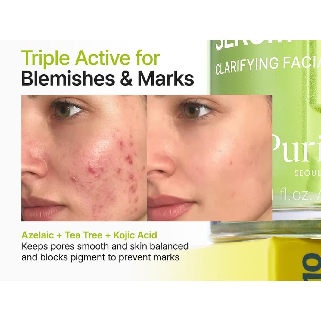 Azelaic Acid 10% + Kojic Acid + Tea Tree Facial Serum | for Acne & Marks, Breakouts | High-Level Azelaic Acid 10% | Korean Skincare, 30Ml 1.01 Fl.Oz