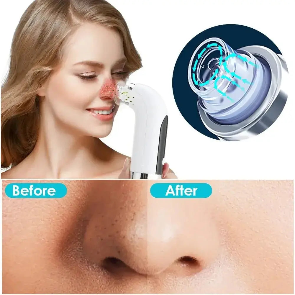 Electric Small Bubble Blackhead Remover - Glam Global UK