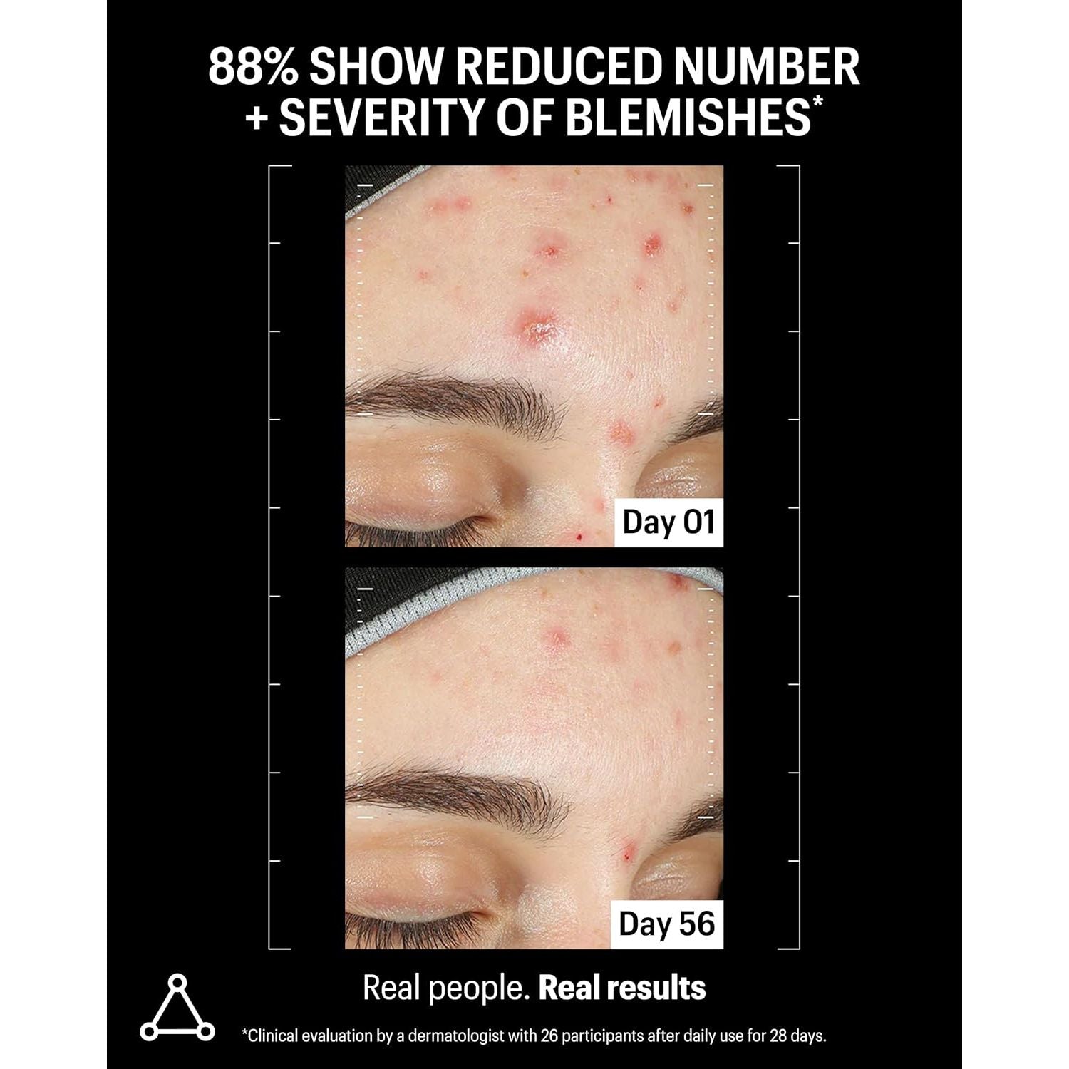 Allies of Skin Azelaic & Kojic Advanced Clarifying Serum – 30ml | 33% Clearer Skin in 1 Month