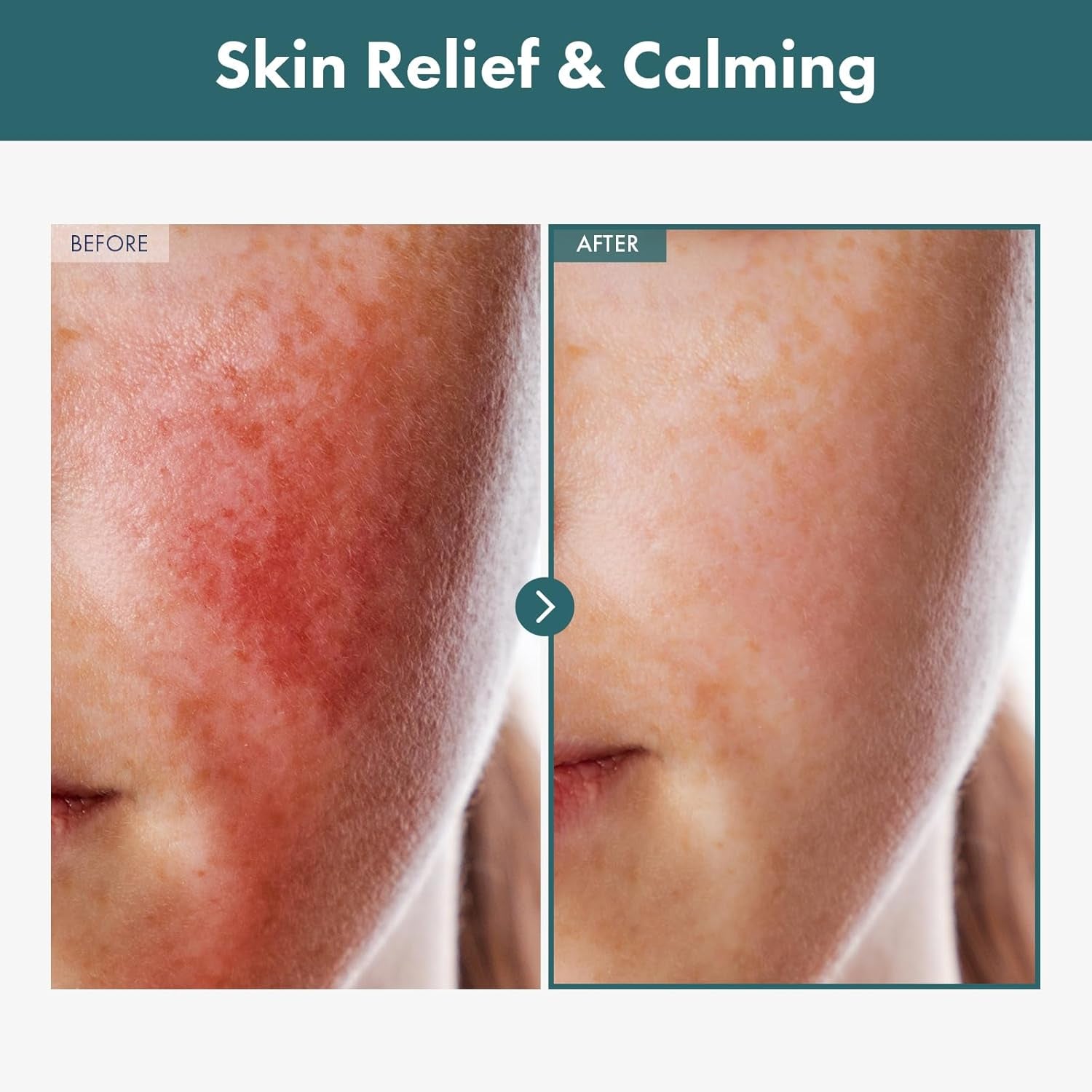 Adenosine Cica Cream, 520,000Ppm Centella Asiatica, Redness Reducing for Oily and Dry Skin Moisturizer, Barrier Cream with Niacinamide and Panthenol, Korean Skincare, 100Ml, 3.38 Fl. Oz.