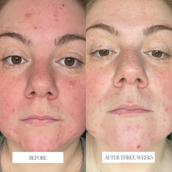 BYROE Celery AHA+ LHA Resurfacing Serum – 30ml | Gentle Exfoliating & Brightening Treatment