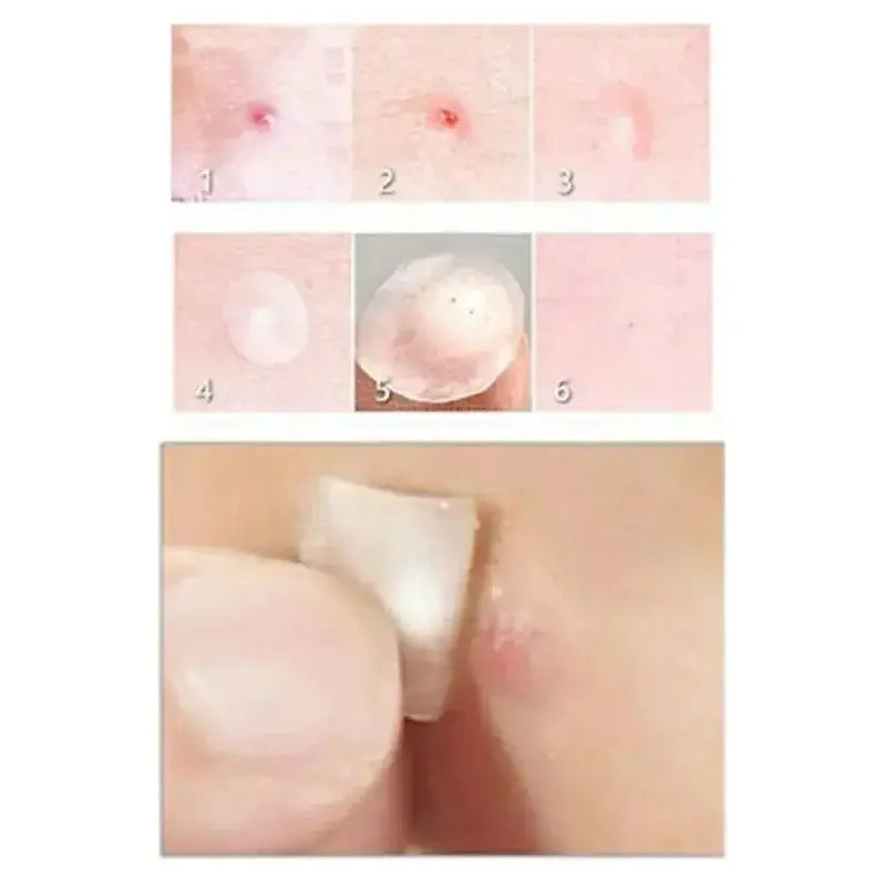 Face Acne Pimple Spot Scar Care Treatment Stickers - Glam Global UK