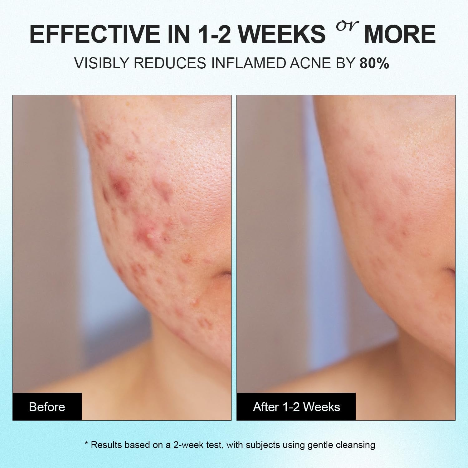 Enaskin Naturals 10% Azelaic Acid Acne Treatment – 50g | Advanced Acne & Scar Defense Gel-Cream