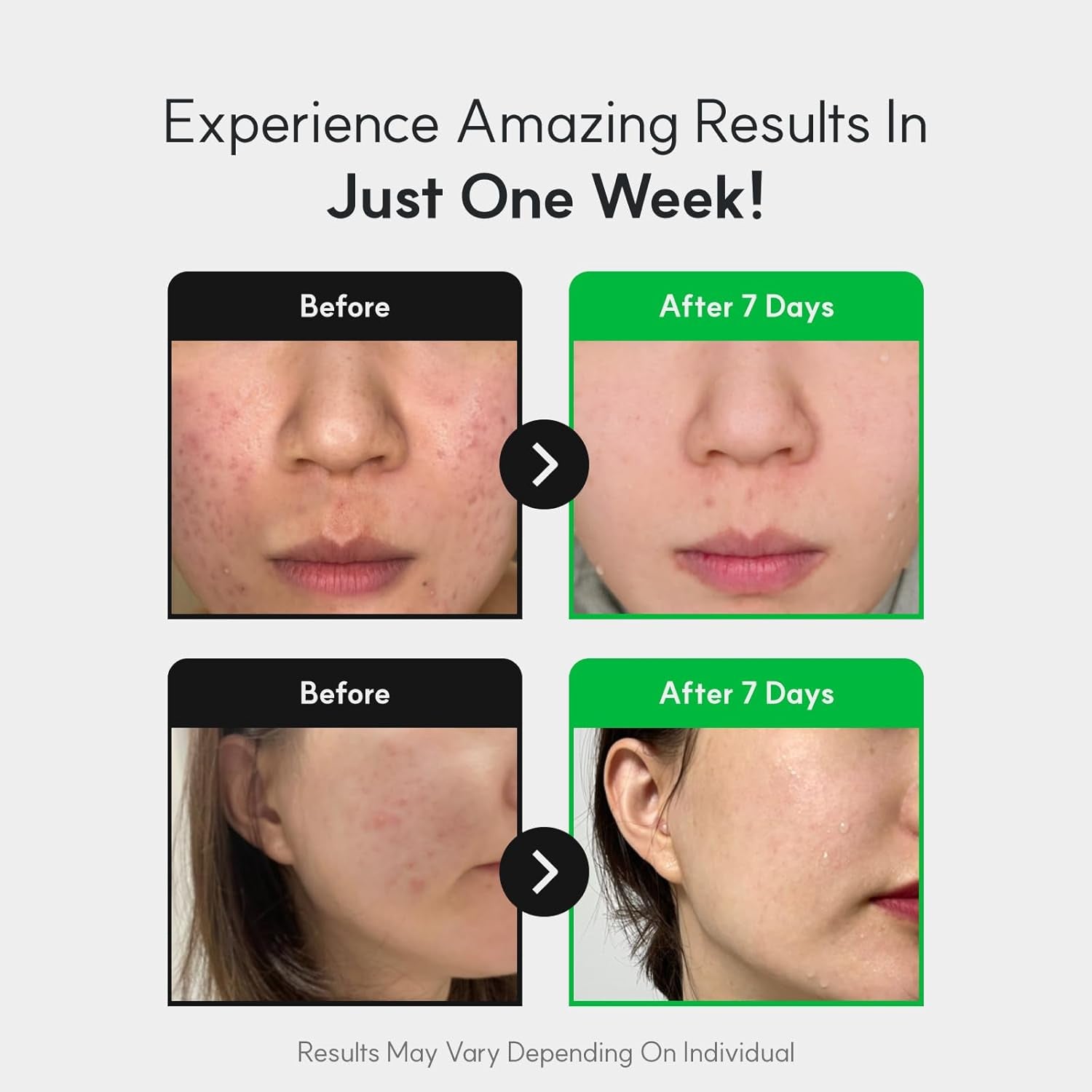 Centelsome 5X Soothing Serum 1.69 Fl Oz/50Ml | for Hydration, Glow, Sensitive, anti Aging, Acne Treatment for Face, Korean Skincare with Centella Asiatica, Exosomes for Skin, Panthenol