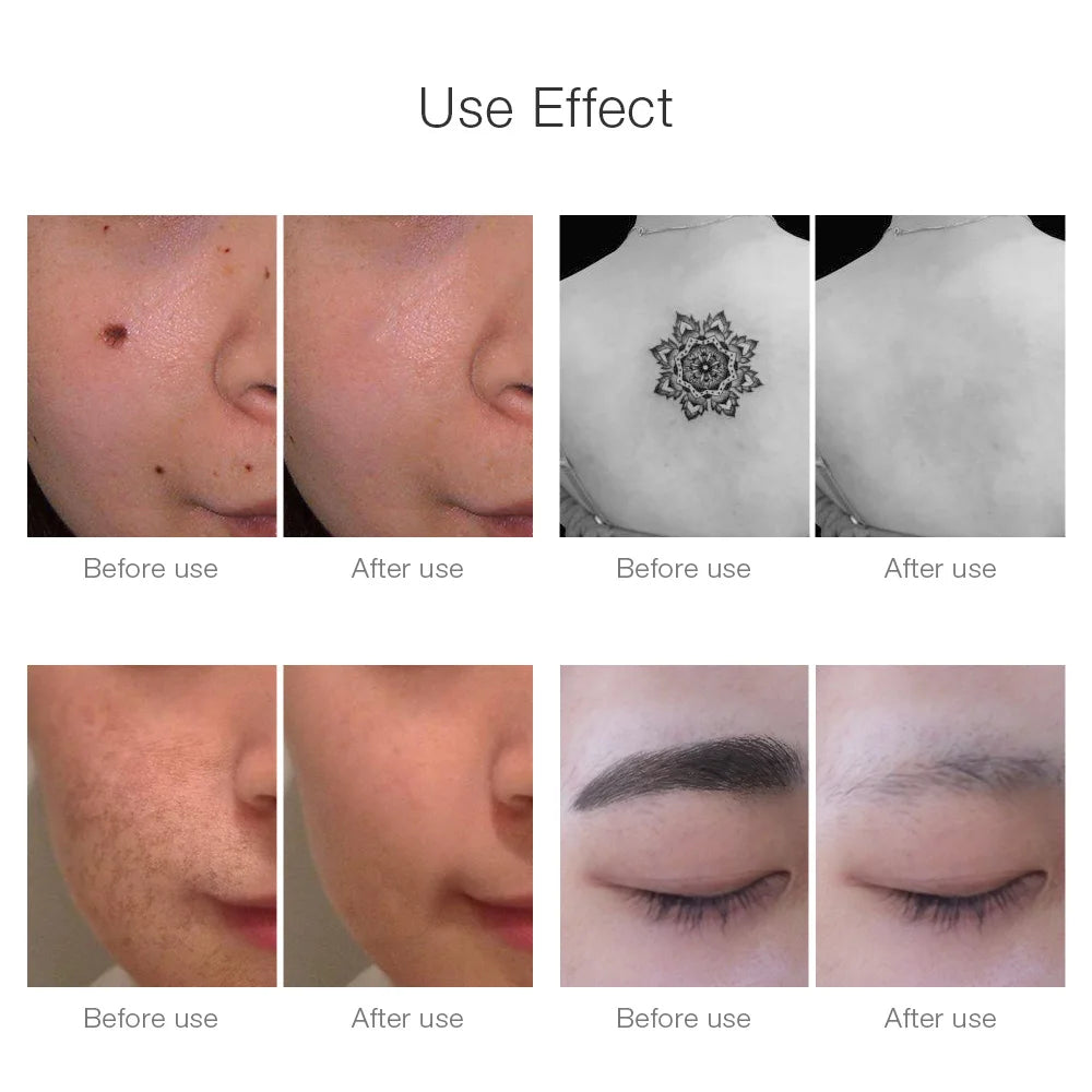 Foreverlily 9+9 Picosecond Laser Pen – Freckle, Mole & Dark Spot Remover (Rechargeable)