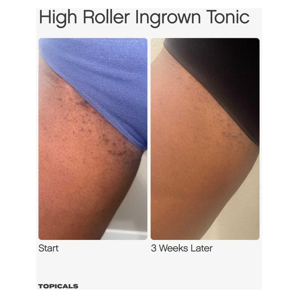 Topicals Ingrown Duo - Glam Global UKTopicals