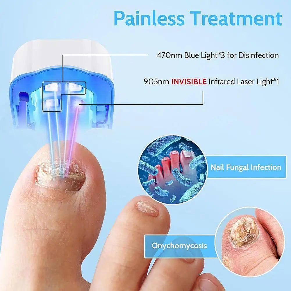 Laser Nail Fungus Treatment Device - Glam Global UK