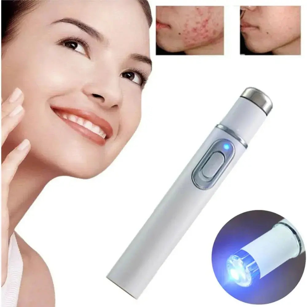 Light Therapy Acne Pen – Advanced LED Treatment for Clearer Skin - Glam Global UK