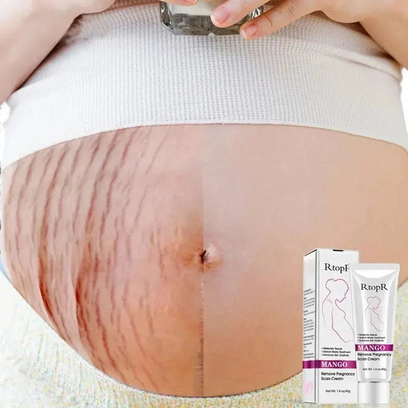 Mango Stretch Mark Cream For Pregnancy Repair - Glam Global UK