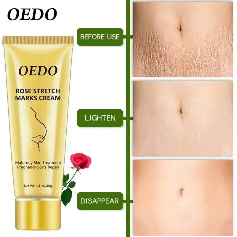 OEDO Stretch Mark Cream - Glam Global UK