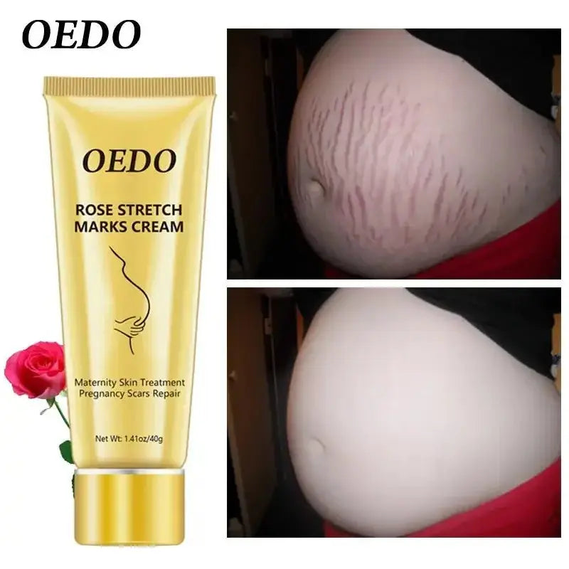 OEDO Stretch Mark Cream - Glam Global UK