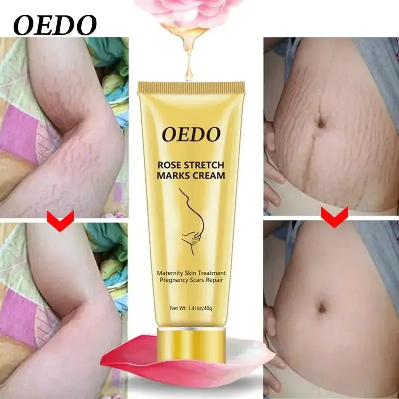 OEDO Stretch Mark Cream - Glam Global UK