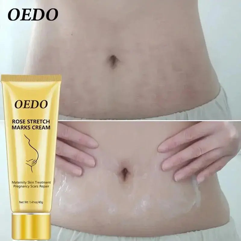 OEDO Stretch Mark Cream - Glam Global UK