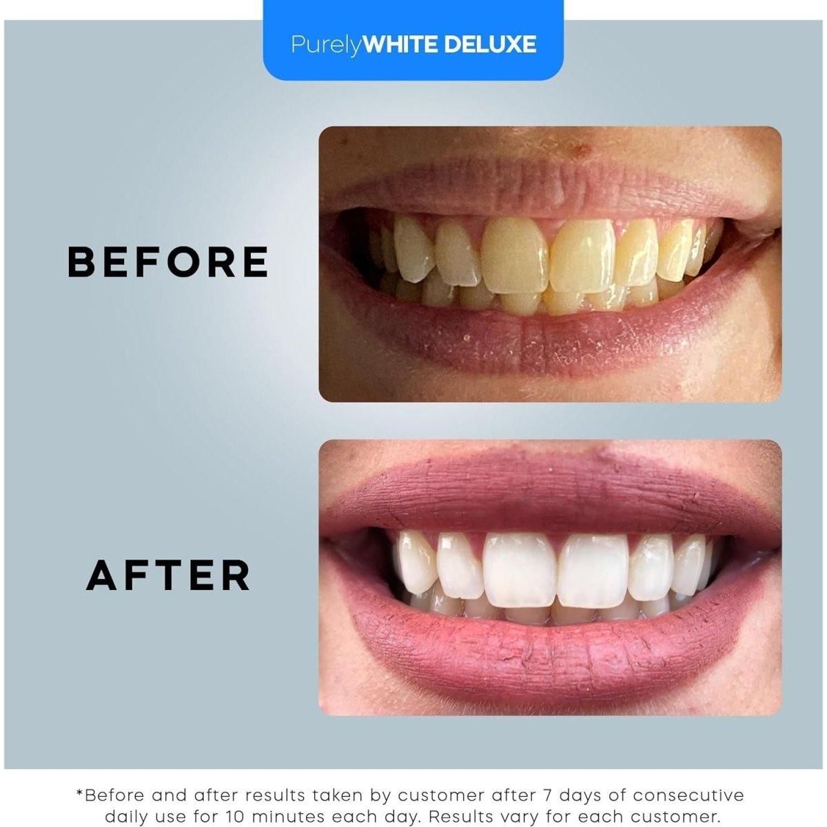 Teeth Whitening Kit, Complete LED Teeth Whitening, 15+ Treatments, (3) 3Ml Whitening Gel Syringes, Whiter Smile in 7 Minutes - Glam Global UK