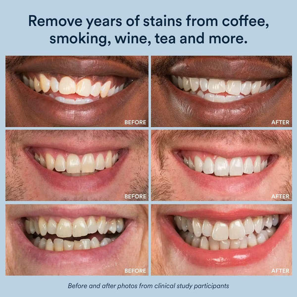 Auraglow Teeth Whitening Kit, LED Accelerator Light, 35% Carbamide Peroxide Teeth Whitening Gel, 20+ Whitening Treatments, (2) 5Ml Whitening Gel Syringes - Glam Global UKAuraglow