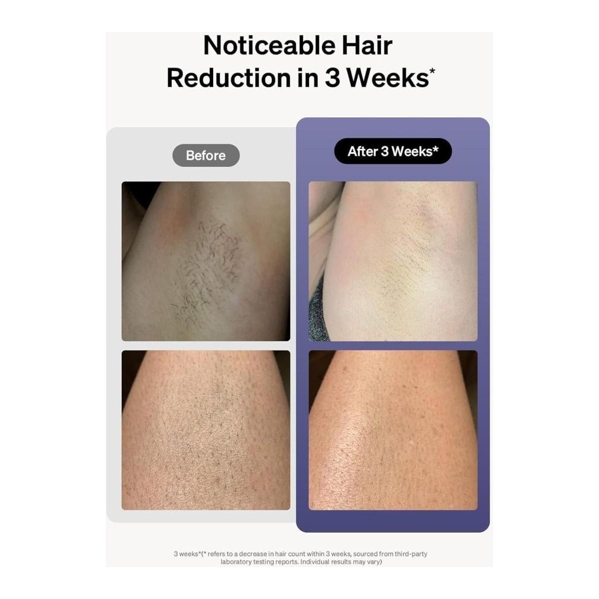 Ulike Laser Hair Removal, Air 10 IPL Hair Removal f - Glam Global UK