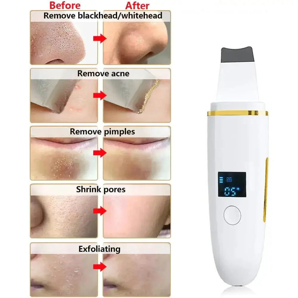 Ultrasonic Skin Scrubber: Professional Facial Cleansing Device - Glam Global UK