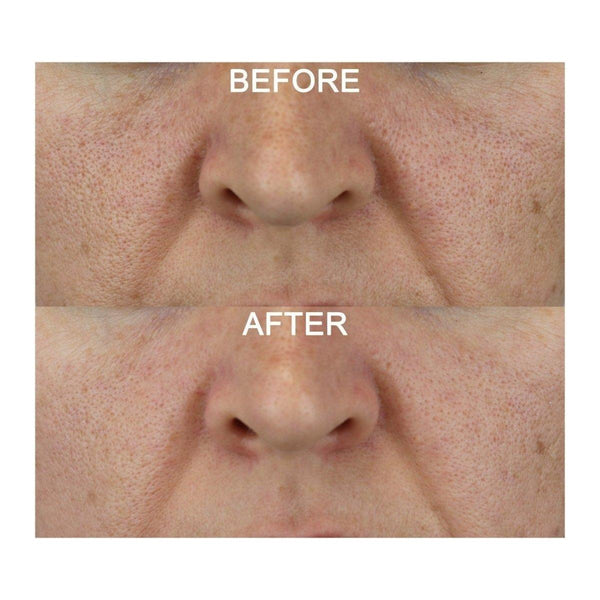 Medik8 Activated Charcoal Refining Mask Kit 4 Masks - Glam Global UKMedik8