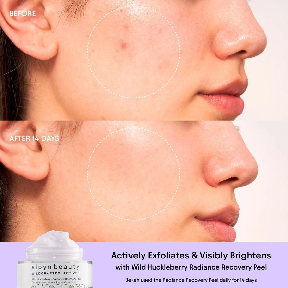 Wild Huckleberry Radiance Recovery Peel - Glam Global UK